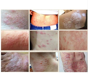 Natural herbal psoriasis cream